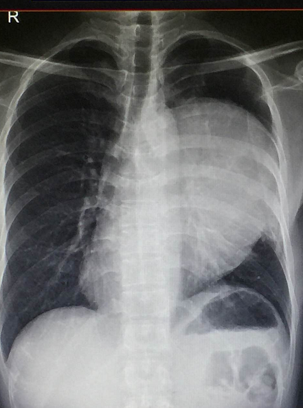 手术前,在X光影像片上,叶先生胸腔内的胸腺类癌巨大,显示清晰。 手术前,在X光影像片上,叶先生胸腔内的胸腺类癌巨大,显示清晰。