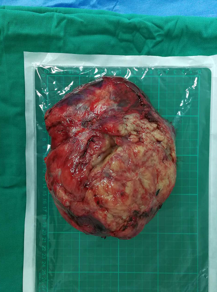 2017年8月2日,香港大学深圳医院胸外科手术团队从叶先生胸腔内顺利切除直径达22厘米的巨大胸腺类癌。 2017年8月2日,香港大学深圳医院胸外科手术团队从叶先生胸腔内顺利切除直径达22厘米的巨大胸腺类癌。