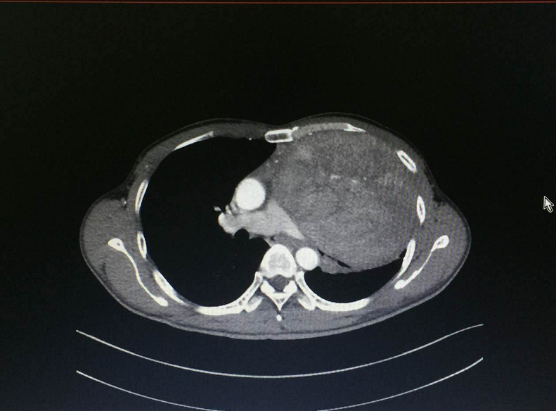 在CT影像片上,叶先生胸腔内的胸腺类癌巨大,显示清晰。 在CT影像片上,叶先生胸腔内的胸腺类癌巨大,显示清晰。