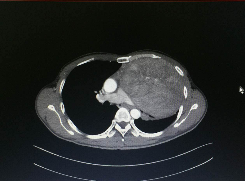 在ct影像片上,叶先生胸腔内的胸腺类癌巨大,显示清晰.