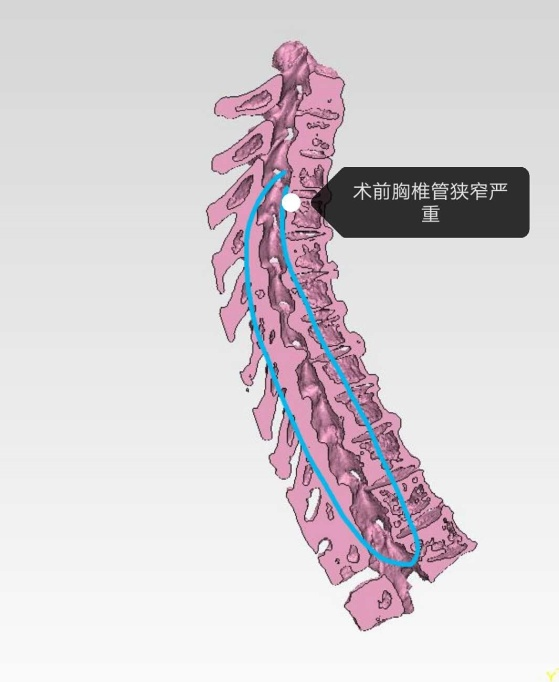 50岁女士胸椎管狭窄得只剩20,3d打印定制成功"减压(转载)