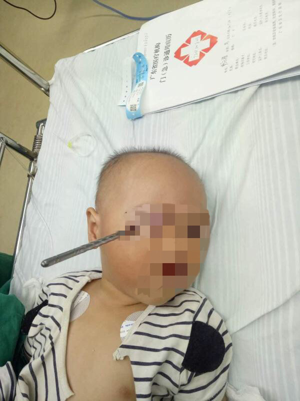 小涛插着筷子被送进急诊