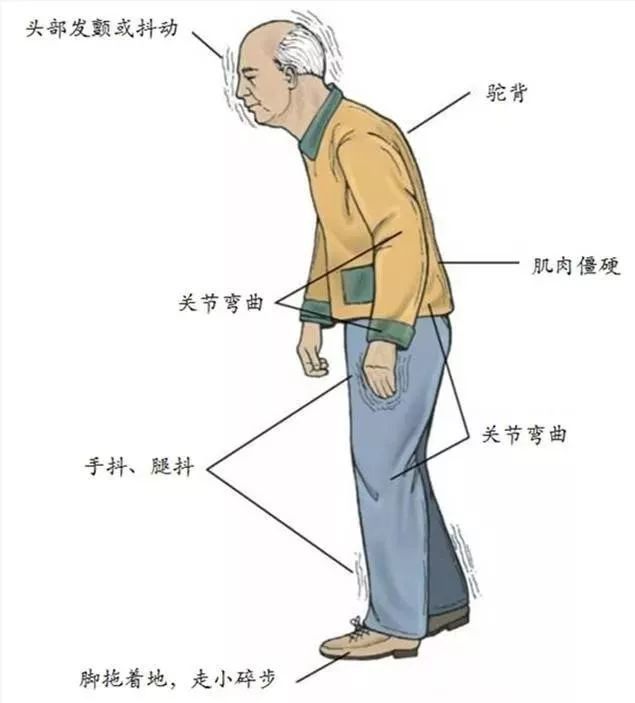 帕金森病主要有以下四个症状:静止性震颤,肌肉强直,动作缓慢和步态