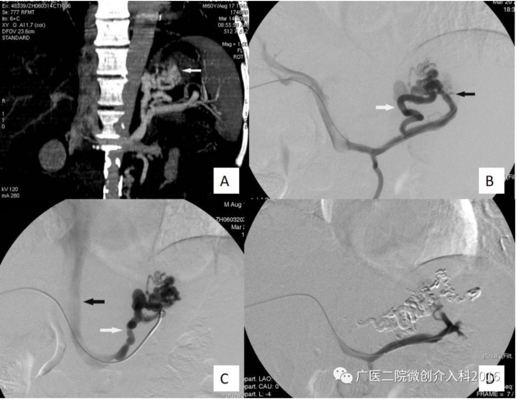 男,53岁,因"呕血600ml"入院,诊断为肝硬化胃底静脉曲张破裂出血,患者