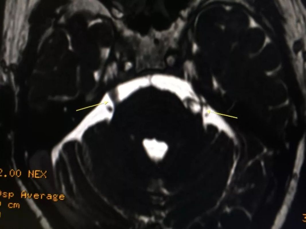 三叉神经痛?核磁共振放大招揪出元凶!——市人民医院