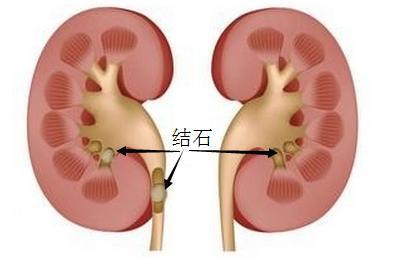 足足一斤,比拳头还大的巨大膀胱结石!连医生都说罕见!