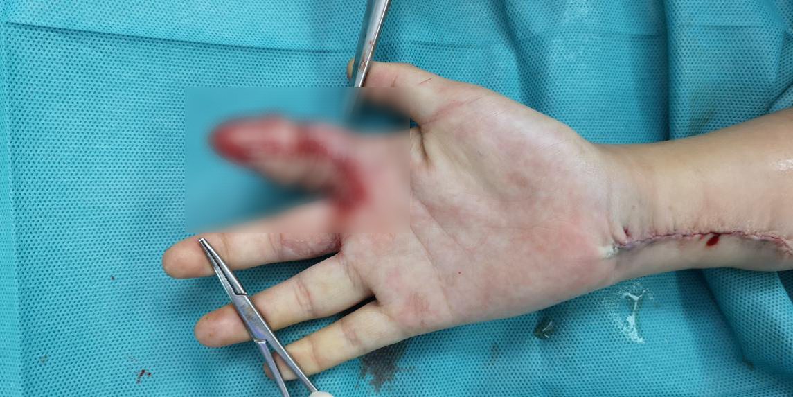 花季少女工厂实习手指被碾压,深圳医生截血管皮瓣挽救