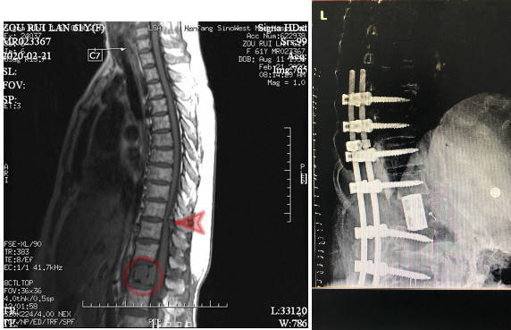 图左：术前MR示腰椎肿瘤（圆圈处）、胸椎狭窄（箭头所指）。图右：术后X光，病变脊椎切除，代以人工椎体。
