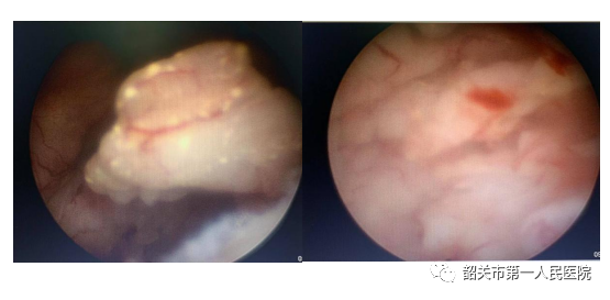 宫内镜怎么进入子宫【高水平医院建设】一探究“镜”新法宝：阴道内镜技术_https://www.jmylbn.com_新闻资讯_第5张