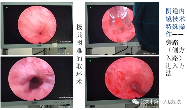 宫内镜怎么进入子宫【高水平医院建设】一探究“镜”新法宝：阴道内镜技术_https://www.jmylbn.com_新闻资讯_第3张