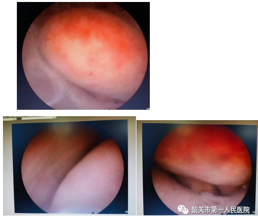 宫内镜怎么进入子宫【高水平医院建设】一探究“镜”新法宝：阴道内镜技术_https://www.jmylbn.com_新闻资讯_第4张