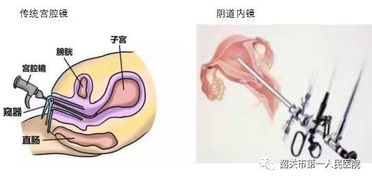 宫内镜怎么进入子宫【高水平医院建设】一探究“镜”新法宝：阴道内镜技术_https://www.jmylbn.com_新闻资讯_第2张
