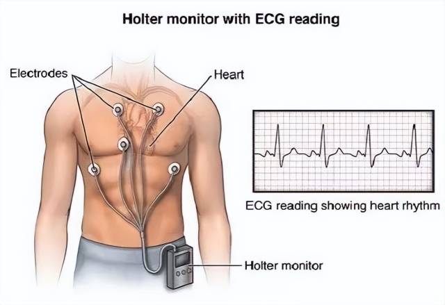 动态心电图自己怎么记录一文读懂！为什么要做动态心电图？_https://www.jmylbn.com_新闻资讯_第3张
