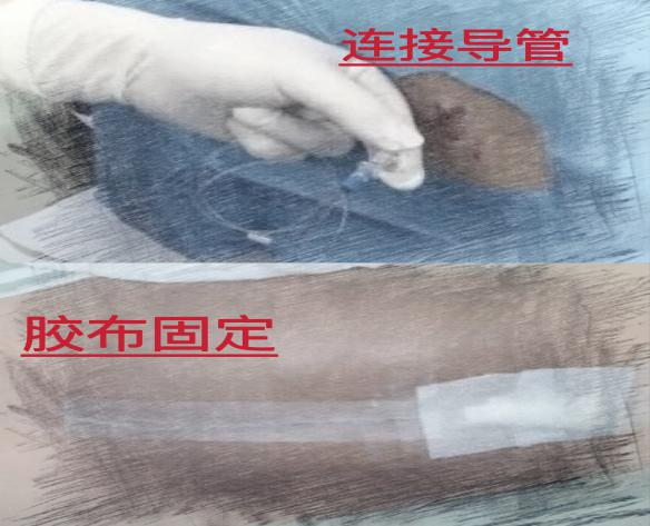 怎么知道穿刺到硬膜外准妈妈看过来，剖宫产麻醉时的“龙虾”体位您学会了吗？_https://www.jmylbn.com_新闻资讯_第7张