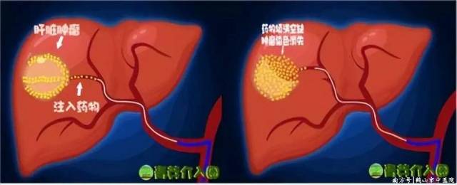介入用的什么设备【微创技术】微创诊疗之肿瘤介入篇——让你不再谈癌色变-上海聚慕医疗器械有限公司