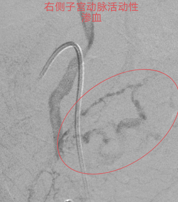 止血医疗设备有哪些重症子痫前期产妇产后大出血生命危在旦夕，龙江医院微创介入栓塞止血疗效佳_https://www.jmylbn.com_新闻资讯_第3张