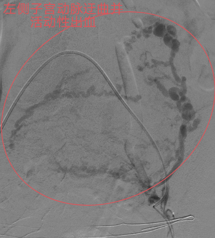止血医疗设备有哪些重症子痫前期产妇产后大出血生命危在旦夕，龙江医院微创介入栓塞止血疗效佳_https://www.jmylbn.com_新闻资讯_第1张