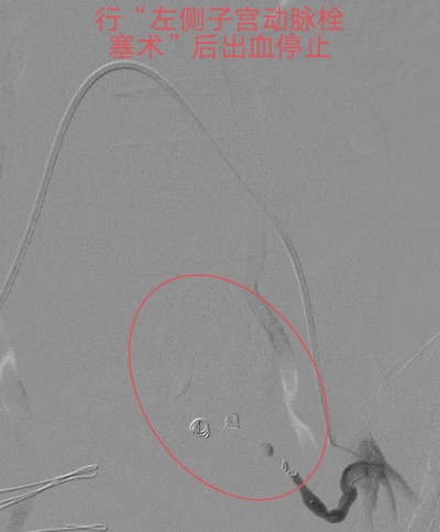 止血医疗设备有哪些重症子痫前期产妇产后大出血生命危在旦夕，龙江医院微创介入栓塞止血疗效佳_https://www.jmylbn.com_新闻资讯_第4张