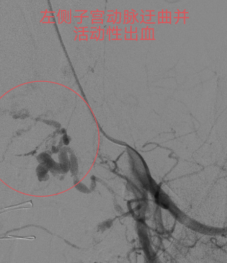 止血医疗设备有哪些重症子痫前期产妇产后大出血生命危在旦夕，龙江医院微创介入栓塞止血疗效佳_https://www.jmylbn.com_新闻资讯_第2张