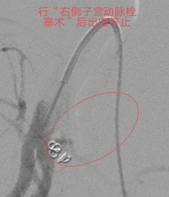 止血医疗设备有哪些重症子痫前期产妇产后大出血生命危在旦夕，龙江医院微创介入栓塞止血疗效佳_https://www.jmylbn.com_新闻资讯_第5张