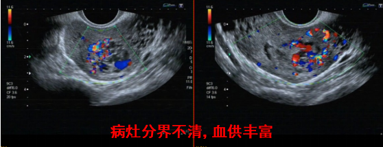 什么是CZF治疗【非常手术】惊险!流产后遭遇绒毛植入,专家“两步走”保护生育力-上海聚慕医疗器械有限公司