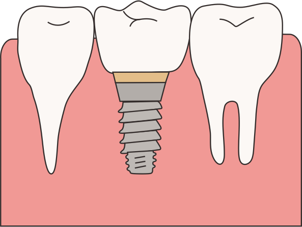 愈合机台怎么识别型号种牙须知，种植牙的一、二、三期分别代表什么？_https://www.jmylbn.com_新闻资讯_第1张