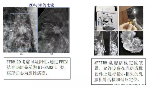 乳腺机为什么叫钼靶不必谈“X线”色变——乳腺钼靶知多少_https://www.jmylbn.com_新闻资讯_第4张