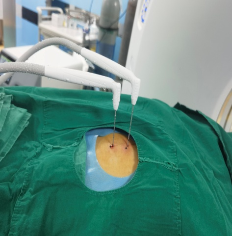 氦氩刀是什么微创消融，以“针”代“刀”，市二医院开展肺癌经皮氩氦刀冷冻消融术_https://www.jmylbn.com_新闻资讯_第2张