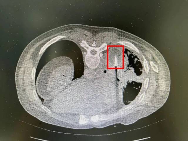 氦氩刀是什么微创消融，以“针”代“刀”，市二医院开展肺癌经皮氩氦刀冷冻消融术_https://www.jmylbn.com_新闻资讯_第3张