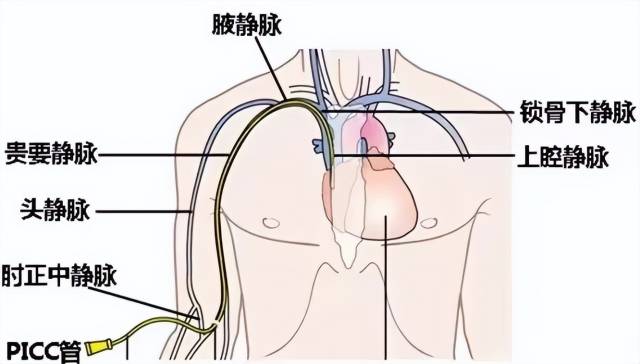 留置引流导管是什么ICU科普：带您认识ICU患者常见管道_https://www.jmylbn.com_新闻资讯_第20张