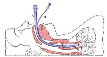 留置引流导管是什么ICU科普：带您认识ICU患者常见管道_https://www.jmylbn.com_新闻资讯_第2张