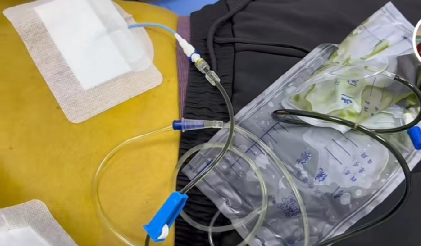 留置引流导管是什么ICU科普：带您认识ICU患者常见管道_https://www.jmylbn.com_新闻资讯_第18张