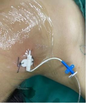 留置引流导管是什么ICU科普：带您认识ICU患者常见管道_https://www.jmylbn.com_新闻资讯_第7张