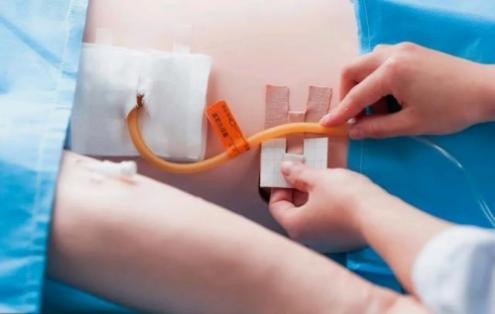 留置引流导管是什么ICU科普：带您认识ICU患者常见管道_https://www.jmylbn.com_新闻资讯_第16张