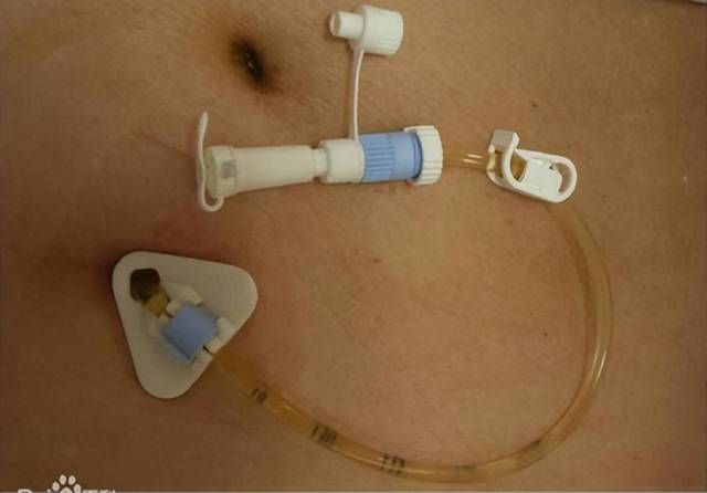留置引流导管是什么ICU科普：带您认识ICU患者常见管道_https://www.jmylbn.com_新闻资讯_第17张