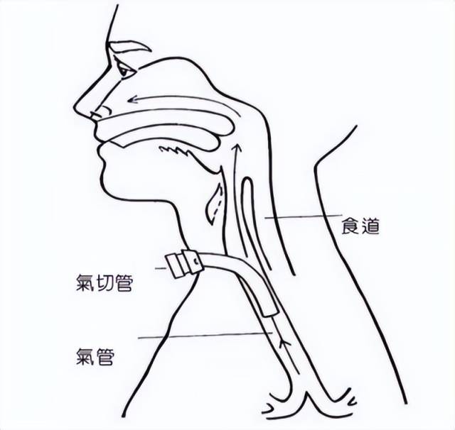 留置引流导管是什么ICU科普：带您认识ICU患者常见管道_https://www.jmylbn.com_新闻资讯_第10张
