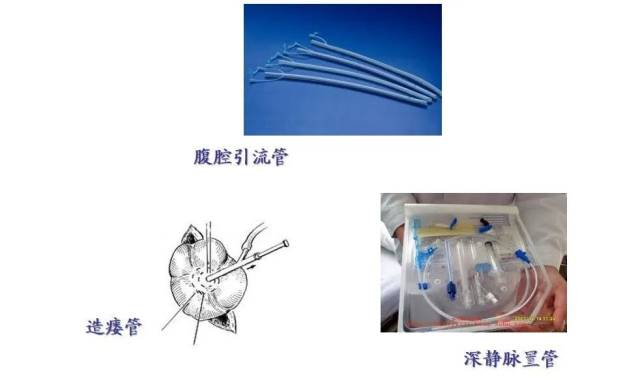 为什么医院的氧气好氧气管、鼻饲管、静脉输液管……生活中需要用心呵护的“生命管道”_https://www.jmylbn.com_新闻资讯_第4张