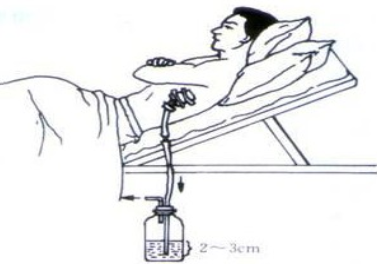 留置引流导管是什么ICU科普：带您认识ICU患者常见管道_https://www.jmylbn.com_新闻资讯_第13张