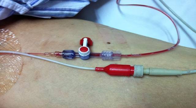 留置引流导管是什么ICU科普：带您认识ICU患者常见管道_https://www.jmylbn.com_新闻资讯_第23张