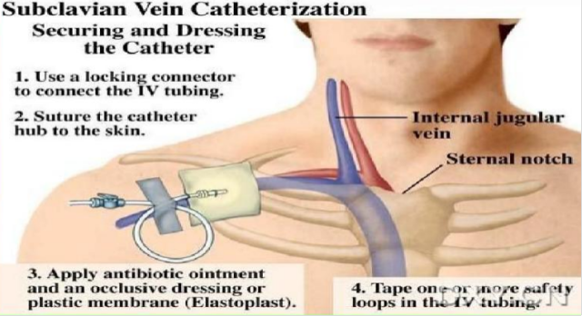 留置引流导管是什么ICU科普：带您认识ICU患者常见管道_https://www.jmylbn.com_新闻资讯_第14张