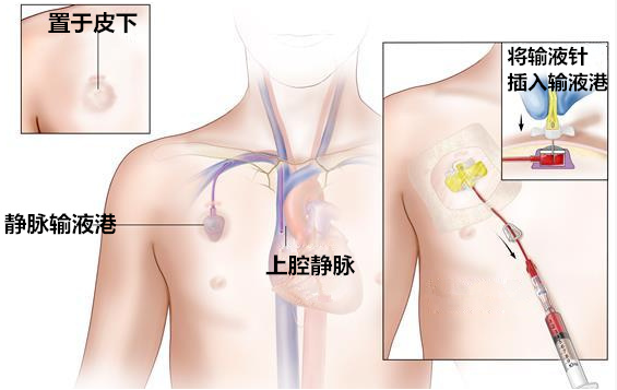 留置引流导管是什么ICU科普：带您认识ICU患者常见管道_https://www.jmylbn.com_新闻资讯_第15张