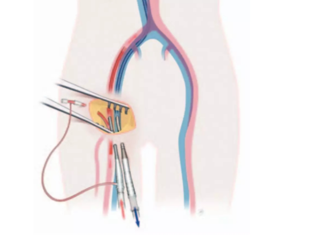 留置引流导管是什么ICU科普：带您认识ICU患者常见管道_https://www.jmylbn.com_新闻资讯_第24张
