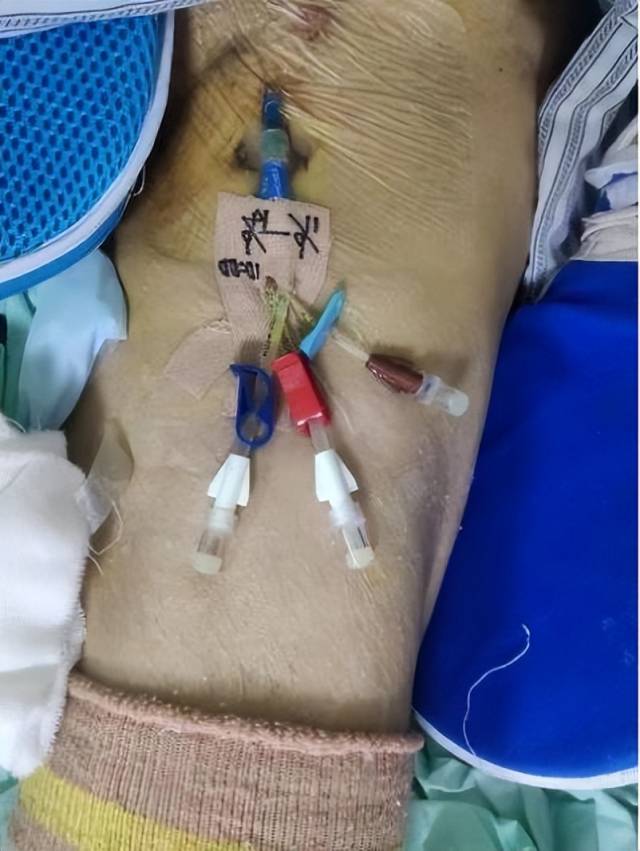 留置引流导管是什么ICU科普：带您认识ICU患者常见管道_https://www.jmylbn.com_新闻资讯_第22张