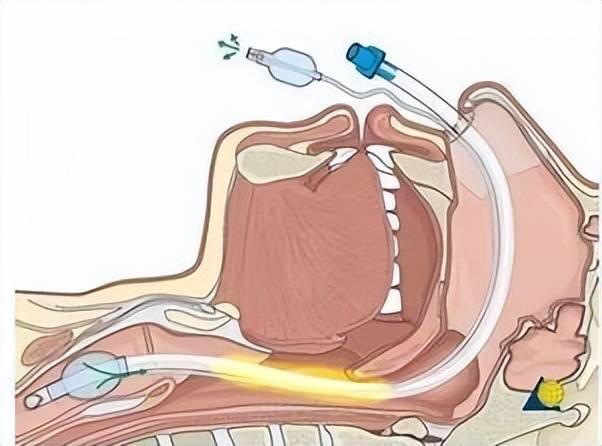 留置引流导管是什么ICU科普：带您认识ICU患者常见管道_https://www.jmylbn.com_新闻资讯_第3张