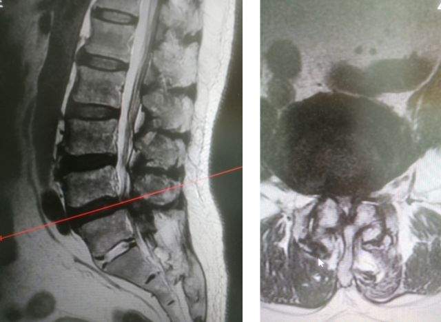 神经阻滞怎么找针【疼痛门诊】不开刀仅用一根针，腰椎间盘疼痛可以这么治！_https://www.jmylbn.com_新闻资讯_第2张