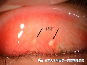 超声波治疗是什么【喜讯】 潮汕医院眼科开展“超声波雾化治疗干眼症”新疗法_https://www.jmylbn.com_新闻资讯_第3张