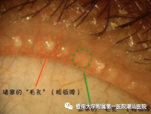 超声波治疗是什么【喜讯】 潮汕医院眼科开展“超声波雾化治疗干眼症”新疗法_https://www.jmylbn.com_新闻资讯_第2张