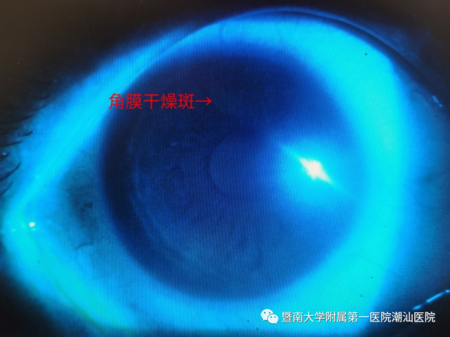 超声波治疗是什么【喜讯】 潮汕医院眼科开展“超声波雾化治疗干眼症”新疗法_https://www.jmylbn.com_新闻资讯_第4张