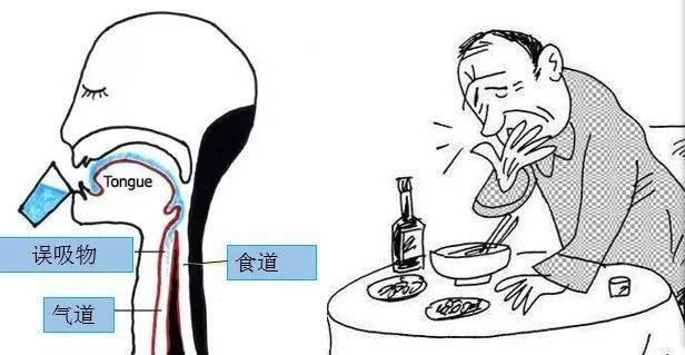 鼻饲胃管什么牌子的好中风后出现吞咽障碍，不重视会出大问题！_https://www.jmylbn.com_新闻资讯_第3张