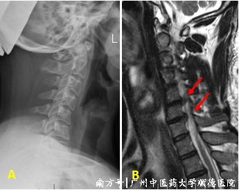 什么是显微镜手术“镜”显神通 精益求精——显微镜下的颈椎手术_https://www.jmylbn.com_新闻资讯_第3张